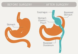 gastric-bypass_reformatted.jpg