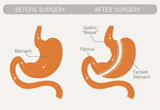 sleeve-gastrectomy_reformatted.jpg